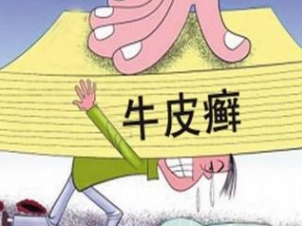 治牛皮癣